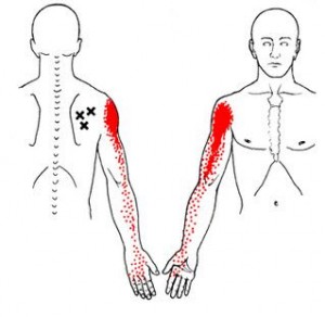 Trigger Points and Shoulder Pain - Infraspinatous TrPs