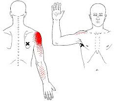 Teres Minor Trigger Point
