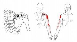 heiler Trigger Points and Shoulder Pain